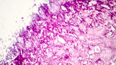 Des molécules vibrantes ont détruit 99 % des cellules cancér ... Image 1