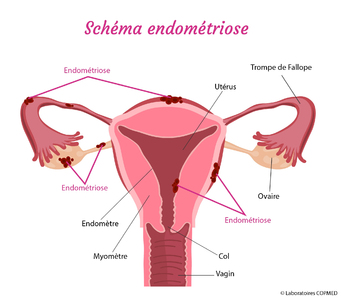 Un test salivaire pour diagnostiquer l'endométriose devrait  ... Image 1