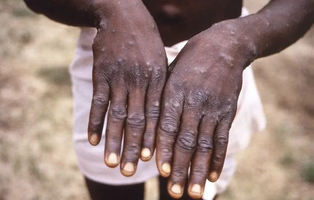 C’est quoi cette nouvelle souche de Mpox qui inquiète pour s ... Image 1
