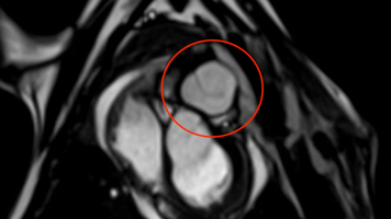 Une valve pulmonaire à base de collagène humain, nouvel espo ... Image 1
