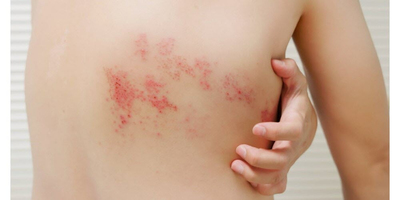 Zona : comment se manifeste ce virus et quelles sont les com ... Image 1