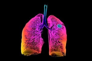 Pourquoi dépiste-on de plus en plus de cancers du poumon che ... Image 1