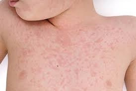 Rougeole : contagieuse et dangereuse… pourquoi il faut absol ... Image 1