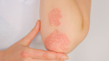 On entend souvent dire que le psoriasis serait d’origine psy ... Image 1