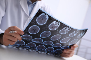 Cancer du cerveau : des associations réclament un meilleur a ... Image 1