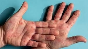 Premier cas du nouveau variant mpox détecté en France. Image 1
