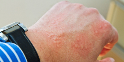 Allergie : mission désensibilisation ! Image 1