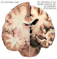 Alzheimer, une avancée majeure : comment le xénon pourrait c ... Image 1