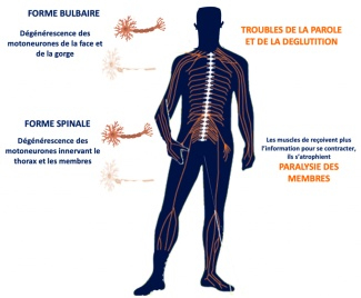 Maladie de Charcot : les troubles du sommeil précèdent l’app ... Image 1