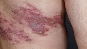 Zona : l’âge et l’immunodépression contribuent lourdement au ... Image 1