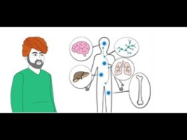 Quid de l’évolution des cancers métastatiques au cours de la ... Image 1